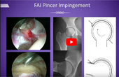Dr. Sanjeev Bhatia of Northwestern Medicine presents as Guest Faculty at AHI: Hip Arthroscopy Pearls