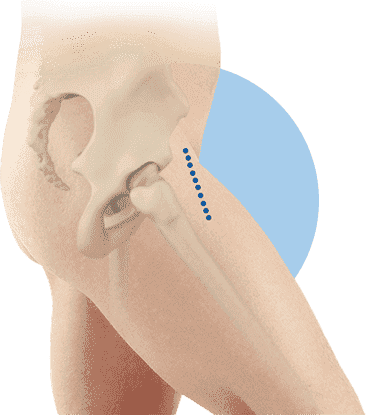 Outpatient Anterior Approach Hip Replacement in American Hip Institute & Orthopedic Specialists