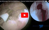 Hip
              Arthroscopy Total Hip Replacement - Iliopsoas Tendon Release for Impingement on a Collared Stem