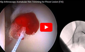 Hip
              Arthroscopy Acetabular Rim Trimming for Pincer Lesion (FAI)