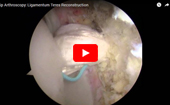 Hip
              Arthroscopy Ligamentum Teres Reconstruction