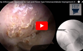 Hip
              Arthroscopy Treatment for Cam and Pincer Type Femoroacetabular Impingement (FAI)