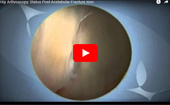 Hip
              Arthroscopy Status Post-Acetabular Fracture