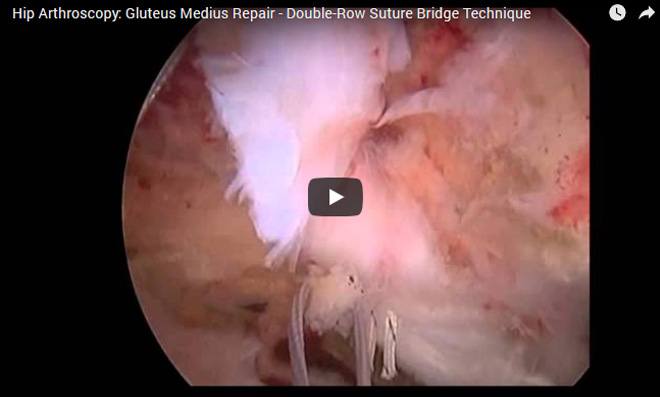 Double-Row Suture Bridge Technique 
