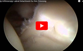 Hip
              Arthroscopy: Labral Detachment for Rim Trimming