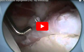 Femoro Acetabular Impingement (FAI)