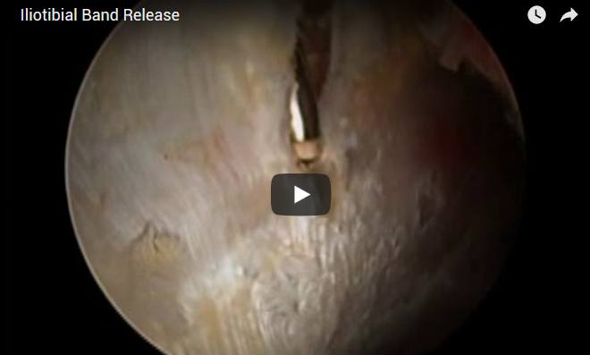 Iliotibial Band Release