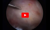 Trochanteric Micropuncture: Treatment for Gluteus Medius Tendinopathy