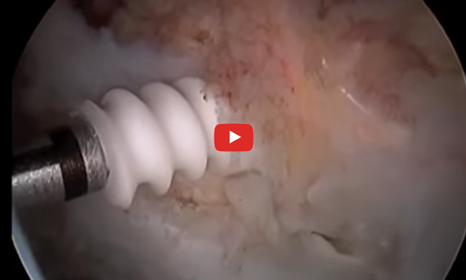 Hip
              Arthroscopy Gluteus Medius Repair Double-Row Suture Bridge Technique