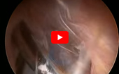 Gluteus
              Medius Repair: Double-Row Suture-Bridge
