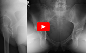 Concommitant Arthroscopy and PAO