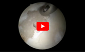 Hip
              Arthroscopy Microfracture Technique